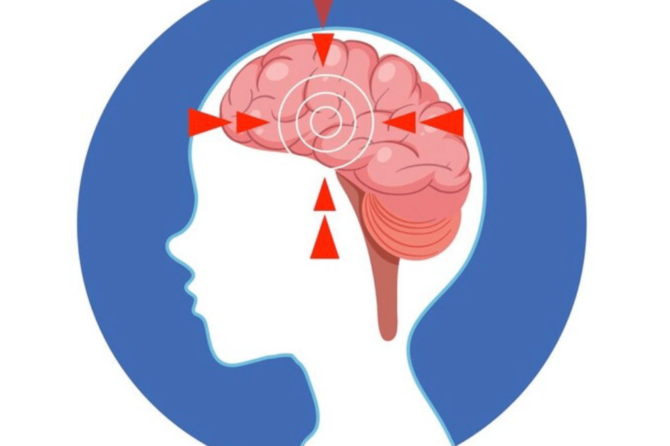 Ictus: qué es y cómo ayuda la fisioterapia en la recuperación